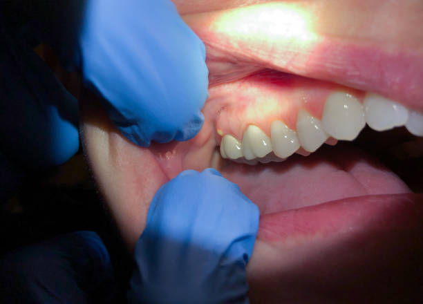 Best Emergency Tooth Extraction in Troy, IL